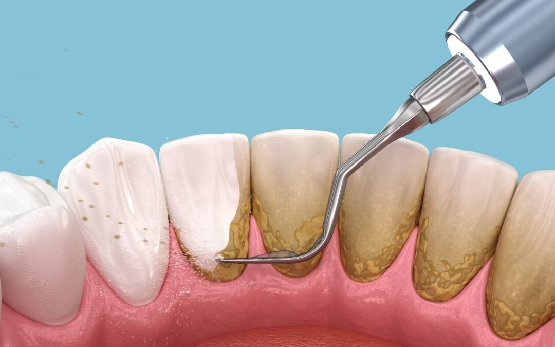 enfermedad periodontal