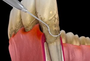 mala higiene enfermedad periodontal