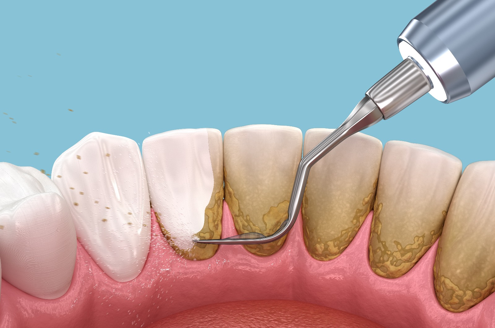 limpieza enfermedad periodontal