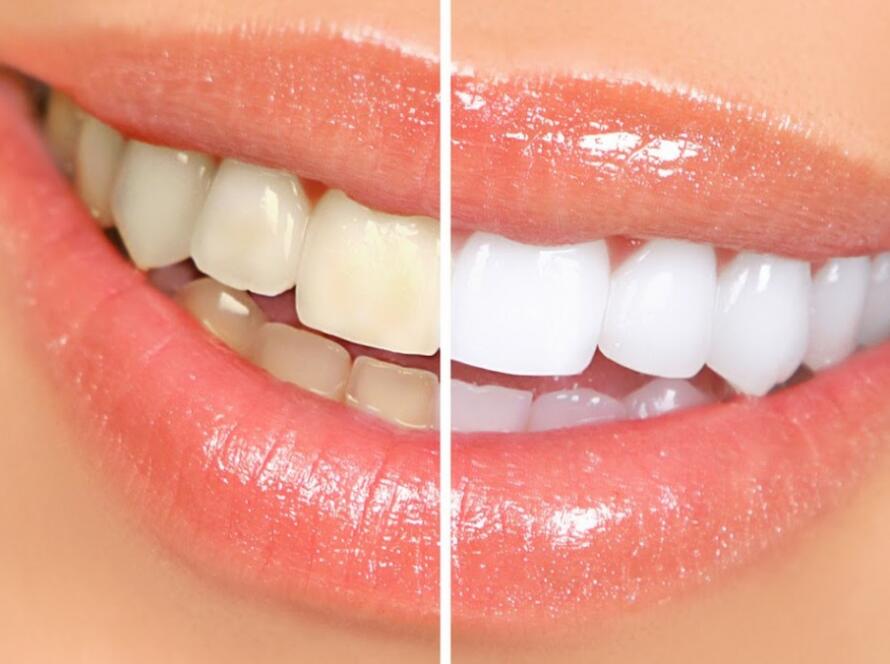 blanqueamiento dental pamplona