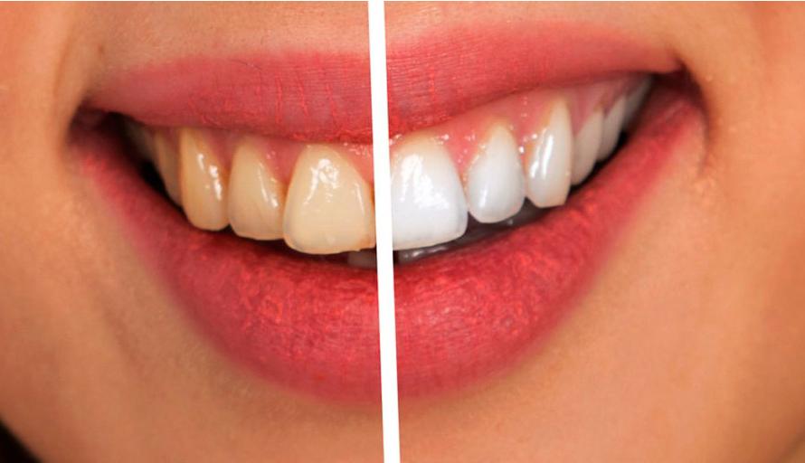 Blanqueamiento y estética dental en Pamplona