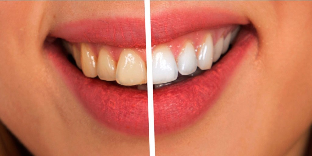 Blanqueamiento profesional