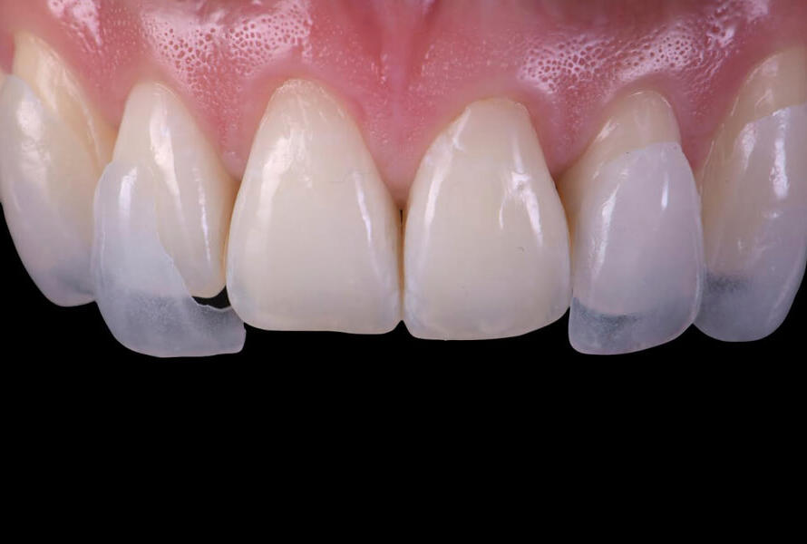 carillas dentales pamplona