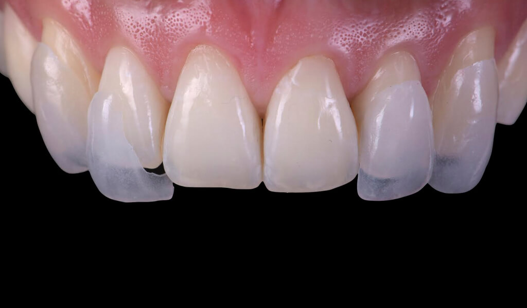 carillas dentales pamplona carillas dentales pamplona