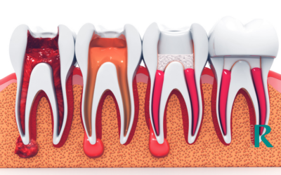 Consecuencias de no tratar una endodoncia