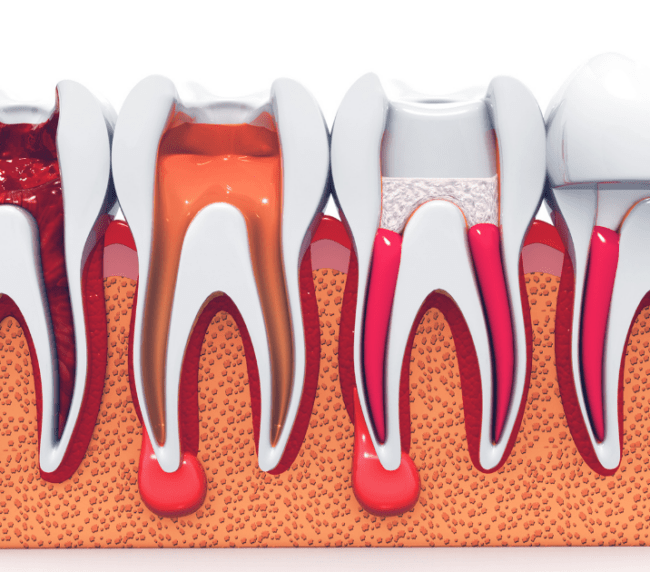 consecuencias de no tratar una endodoncia