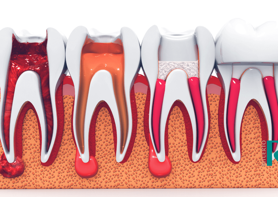 consecuencias de no tratar una endodoncia