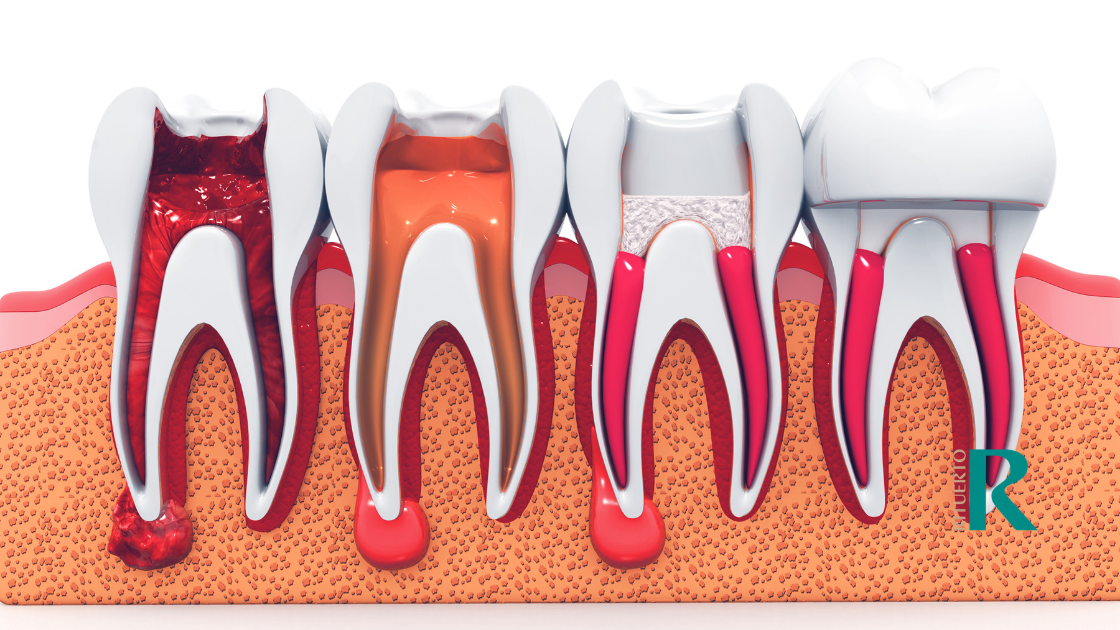 consecuencias de no tratar una endodoncia consecuencias de no tratar una endodoncia