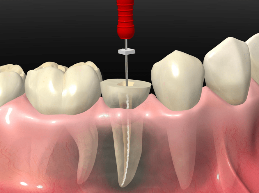 endodoncia en pamplona