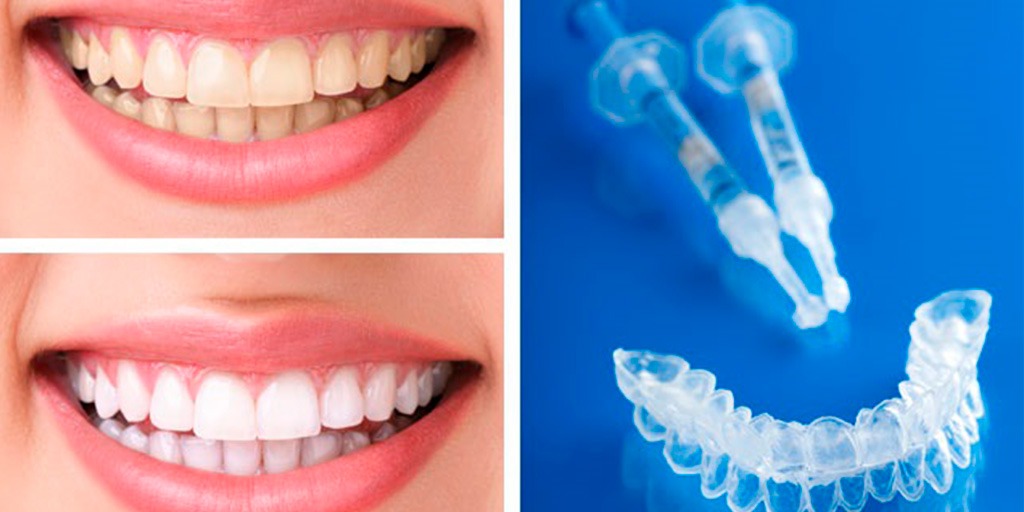 Blanqueamiento ambulatorio