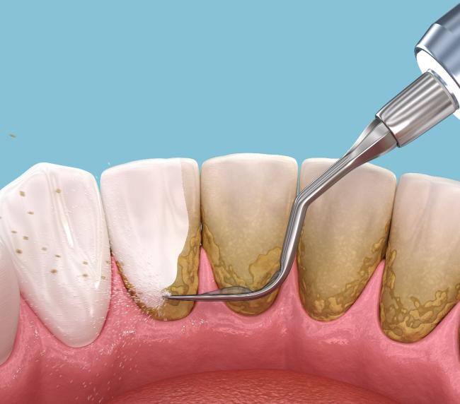 Limpieza dental en Pamplona