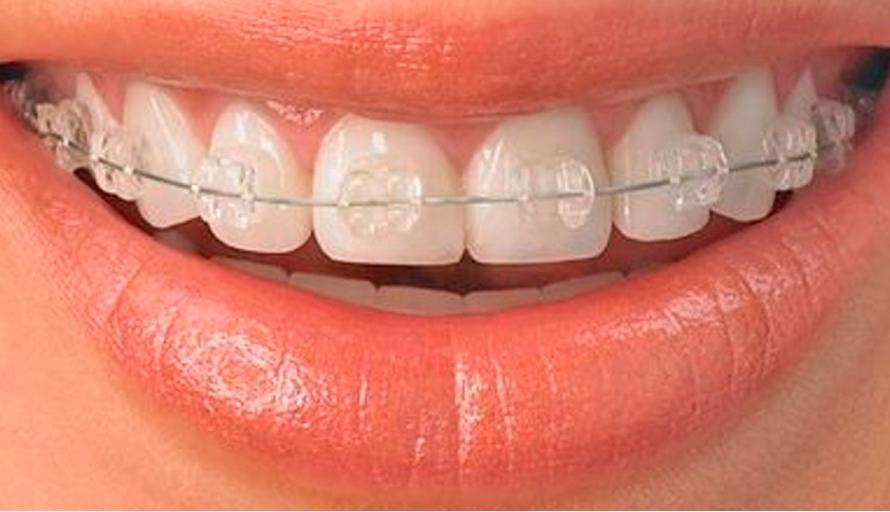 ortodoncia transparente en Pamplona