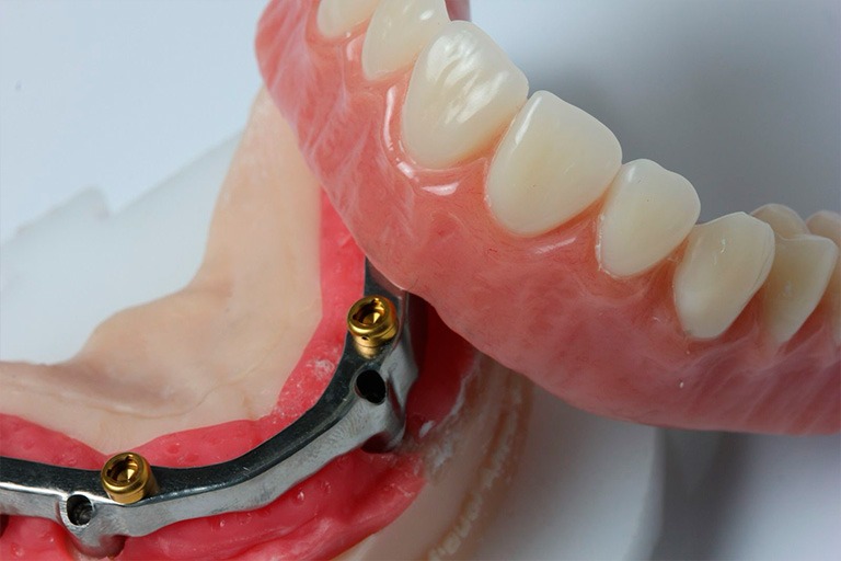 Prótesis Dental en Pamplona