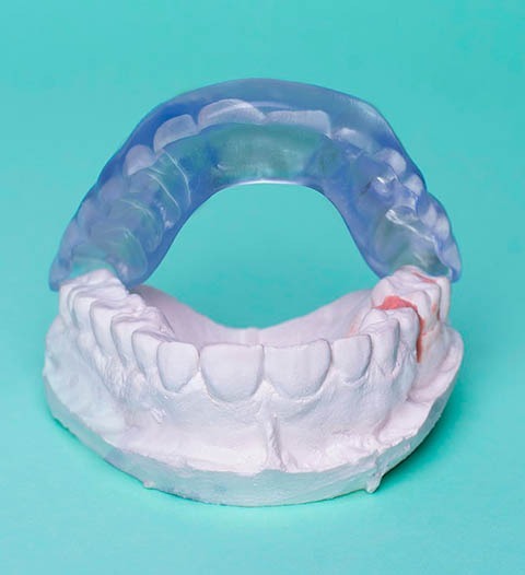 Placa para Bruxismo en Pamplona